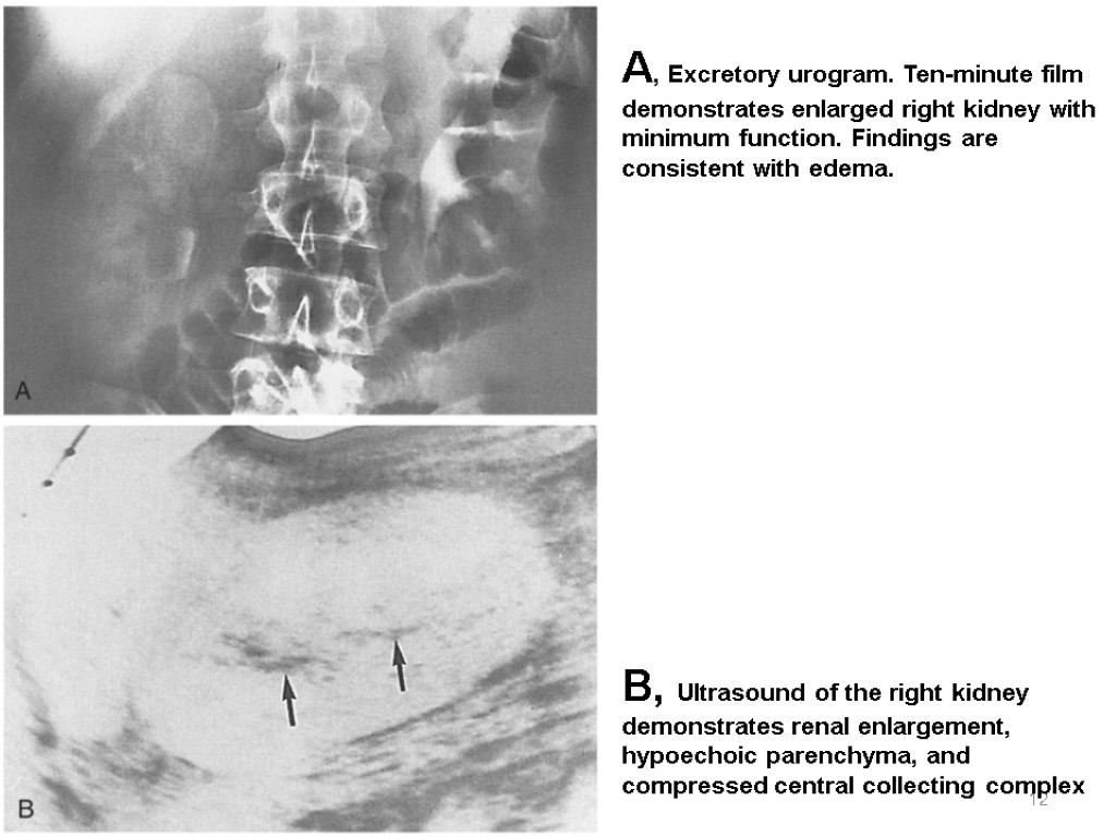 12 A, Excretory urogram. Ten-minute film demonstrates enlarged right kidney with minimum function. Findings